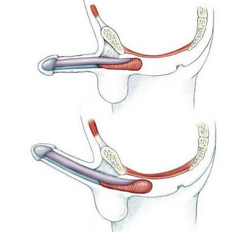 Penis ohne Training des Musculus pubococcygeus und danach